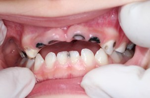 Many children without access to dental care face loss of teeth due to decay.  Courtesy of Dr. Cissy Furusho