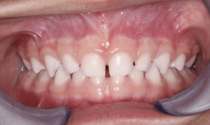 Healthy mouth – no cavities present. Courtesy of Dr. Cissy Furusho Chicago’s 2008-2009 Healthy Smiles, Healthy Growth Survey (HSHGS) of Chicago third graders, found untreated dental cavities in 35.6 percent of the children, at least one sealant present in 34.3 percent of children and 63.5 percent of children to have had dental cavities at 